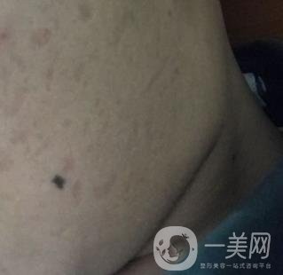 廣州名韓整形醫(yī)院價(jià)格表費(fèi)用詳情+激光祛斑案例分享