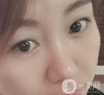 廣州壹加壹整形醫(yī)院做雙眼皮咋樣?案例+價格表詳覽