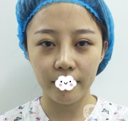 合肥中山醫(yī)院整形科價格表2020，附雙眼皮恢復*果