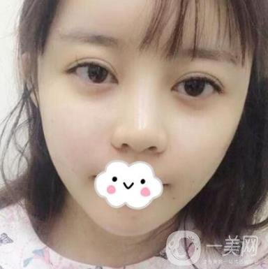 合肥中山醫(yī)院整形科價格表2020，附雙眼皮恢復*果