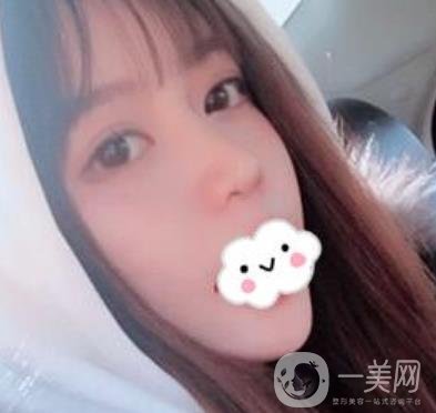 合肥中山醫(yī)院整形科價格表2020，附雙眼皮恢復*果