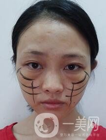 徐州亞韓整形醫(yī)院價格表費用明細，附面部除皺日記展示