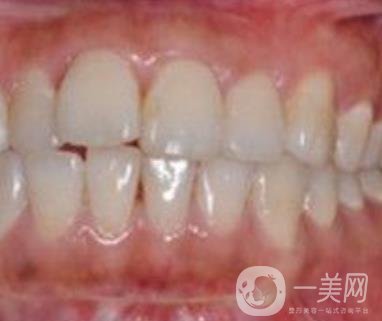 武漢大學(xué)口腔醫(yī)院牙齒矯正多少錢?*果好嗎?價(jià)格費(fèi)用明細(xì)一覽