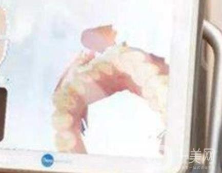 武漢大學(xué)口腔醫(yī)院牙齒矯正多少錢?*果好嗎?價(jià)格費(fèi)用明細(xì)一覽