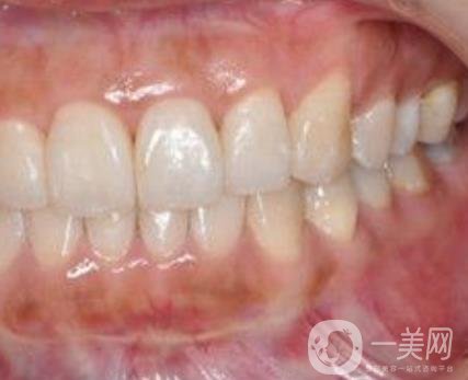 武漢大學(xué)口腔醫(yī)院牙齒矯正多少錢?*果好嗎?價(jià)格費(fèi)用明細(xì)一覽