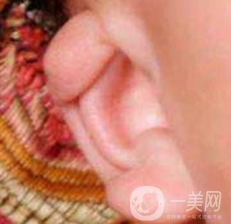 中國(guó)醫(yī)學(xué)科學(xué)院整形外科醫(yī)院外耳再造技術(shù)如何?*果好嗎?價(jià)格表收費(fèi)標(biāo)準(zhǔn)一覽