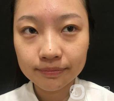 北京知音醫(yī)療美容熱瑪吉*果怎么樣？貴嗎？收費價格表2020公布