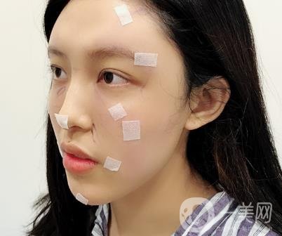 成都美容整形醫(yī)院做脂肪填充全臉*果靠譜嗎?近期價格表和案例參考