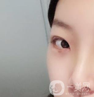 無錫二院雙眼皮做得好的醫(yī)生?附2020整形價格表及案例