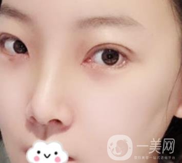 無錫二院雙眼皮做得好的醫(yī)生?附2020整形價格表及案例