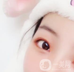 無錫二院雙眼皮做得好的醫(yī)生?附2020整形價格表及案例