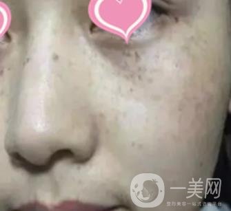 徐州二院激光祛斑怎么樣?案例及2020整形價(jià)格表一覽