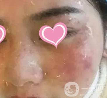 徐州二院激光祛斑怎么樣?案例及2020整形價(jià)格表一覽