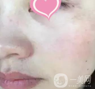 徐州二院激光祛斑怎么樣?案例及2020整形價(jià)格表一覽