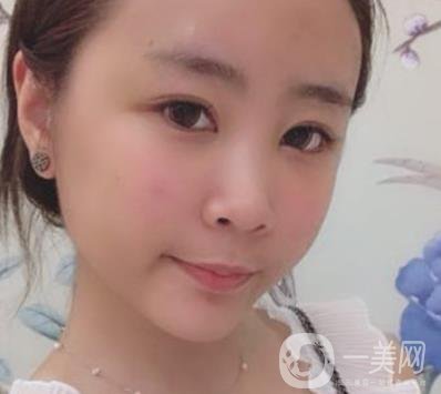 重醫(yī)附一院祛痣多少錢一顆?2020整形價格表及案例*果圖分享