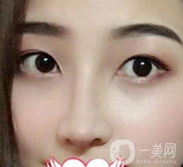 交大一附院王瑞做鼻子怎么樣？?jī)r(jià)格表及術(shù)后*果分享