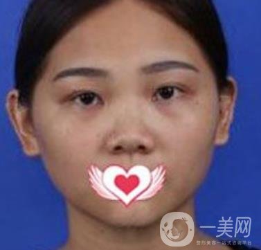 交大一附院王瑞做鼻子怎么樣？?jī)r(jià)格表及術(shù)后*果分享