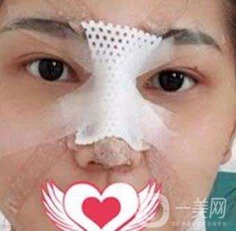 交大一附院王瑞做鼻子怎么樣？?jī)r(jià)格表及術(shù)后*果分享