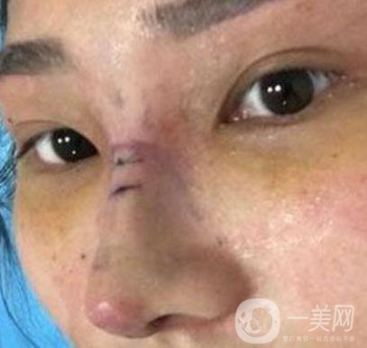 交大一附院王瑞做鼻子怎么樣？?jī)r(jià)格表及術(shù)后*果分享