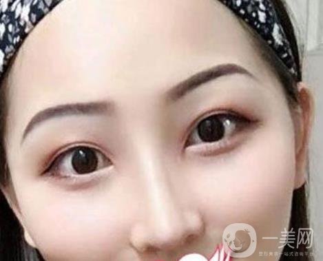 交大一附院王瑞做鼻子怎么樣？?jī)r(jià)格表及術(shù)后*果分享