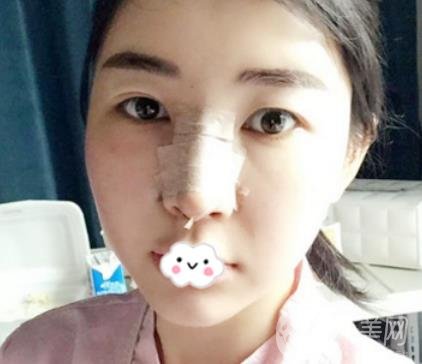 南昌二附院整形科新版價格表發(fā)布,附隆鼻案例前后