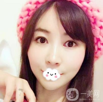 南昌二附院整形科新版價格表發(fā)布,附隆鼻案例前后