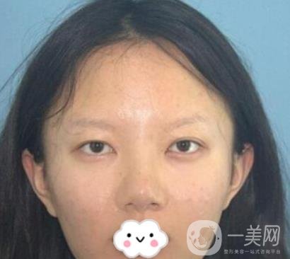 贛南醫(yī)學院第一附屬醫(yī)院整形美容科價格表2020+雙眼皮案例一覽