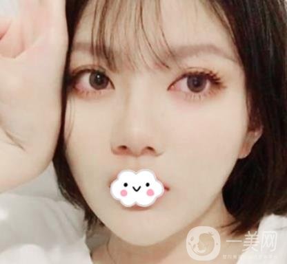 贛南醫(yī)學院第一附屬醫(yī)院整形美容科價格表2020+雙眼皮案例一覽