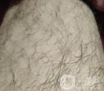 合肥華美整形醫(yī)院價(jià)格表，附脫毛案例