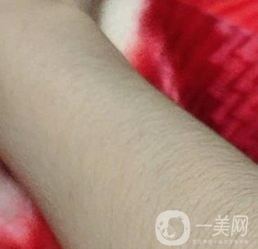 合肥華美整形醫(yī)院價(jià)格表，附脫毛案例