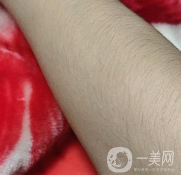 合肥華美整形醫(yī)院價(jià)格表，附脫毛案例