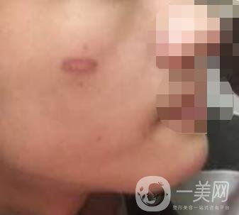 徐州第一人民醫(yī)院整形科價(jià)格表，含激光祛疤*果