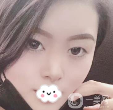 徐州亞韓整形醫(yī)院價(jià)格表2020新版+雙眼皮整形日記一覽