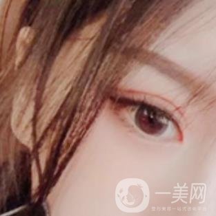 徐州亞韓整形醫(yī)院價(jià)格表2020新版+雙眼皮整形日記一覽