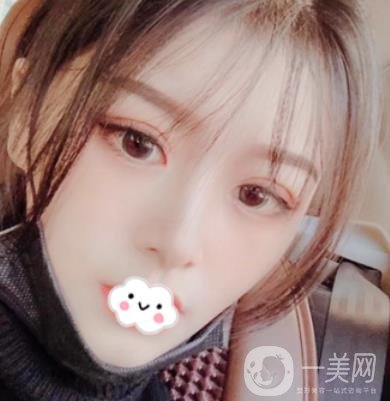 徐州亞韓整形醫(yī)院價(jià)格表2020新版+雙眼皮整形日記一覽