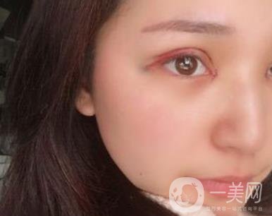 恩施州中心醫(yī)院美容整形科怎么樣？價(jià)格表和雙眼皮整形經(jīng)歷分享