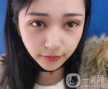 恩施州中心醫(yī)院美容整形科怎么樣？價(jià)格表和雙眼皮整形經(jīng)歷分享