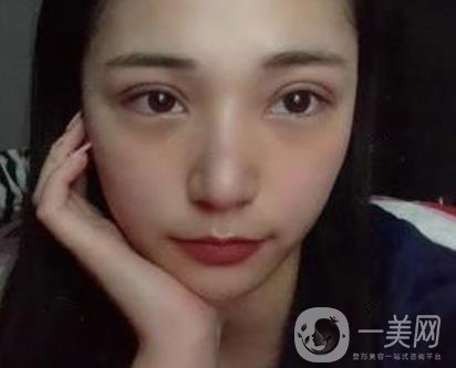 恩施州中心醫(yī)院美容整形科怎么樣？價(jià)格表和雙眼皮整形經(jīng)歷分享