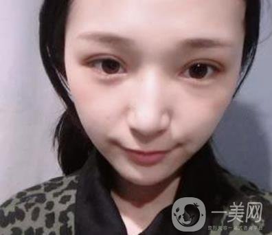 恩施州中心醫(yī)院美容整形科怎么樣？價(jià)格表和雙眼皮整形經(jīng)歷分享