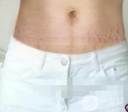 汾陽(yáng)醫(yī)院美容整形科祛妊娠紋怎么樣？手術(shù)項(xiàng)目收費(fèi)價(jià)格表和案例一覽