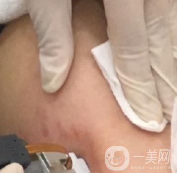 汾陽(yáng)醫(yī)院美容整形科祛妊娠紋怎么樣？手術(shù)項(xiàng)目收費(fèi)價(jià)格表和案例一覽