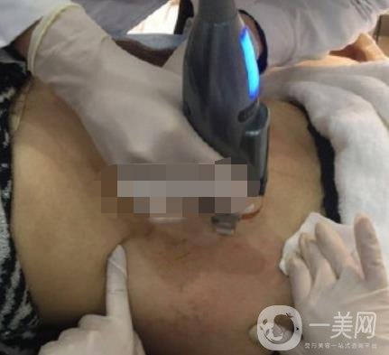 汾陽(yáng)醫(yī)院美容整形科祛妊娠紋怎么樣？手術(shù)項(xiàng)目收費(fèi)價(jià)格表和案例一覽