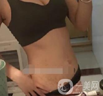 汾陽(yáng)醫(yī)院美容整形科祛妊娠紋怎么樣？手術(shù)項(xiàng)目收費(fèi)價(jià)格表和案例一覽