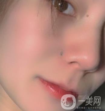 黃岡市中心醫(yī)院美容整形科祛痣多少錢？價格費(fèi)用表和*果圖精選