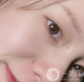 黃岡市中心醫(yī)院美容整形科祛痣多少錢？價格費(fèi)用表和*果圖精選