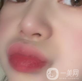 黃岡市中心醫(yī)院美容整形科祛痣多少錢？價格費(fèi)用表和*果圖精選