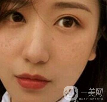 荊州市第三人民醫(yī)院整形美容科*祛斑*果好嗎？收費(fèi)價(jià)格明細(xì)表一覽