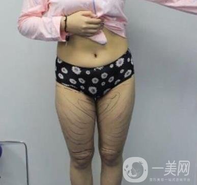 武漢市武昌醫(yī)院整形美容科價格表和吸脂瘦大腿案例精選圖公布