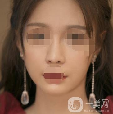 河北省人民醫(yī)院激光祛斑多少錢?附2020整形價(jià)格表一覽