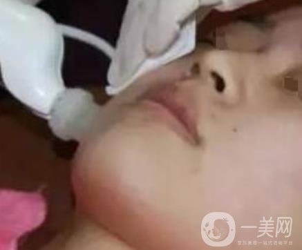 湖南省人民醫(yī)院點陣激光祛斑價格表及案例分享